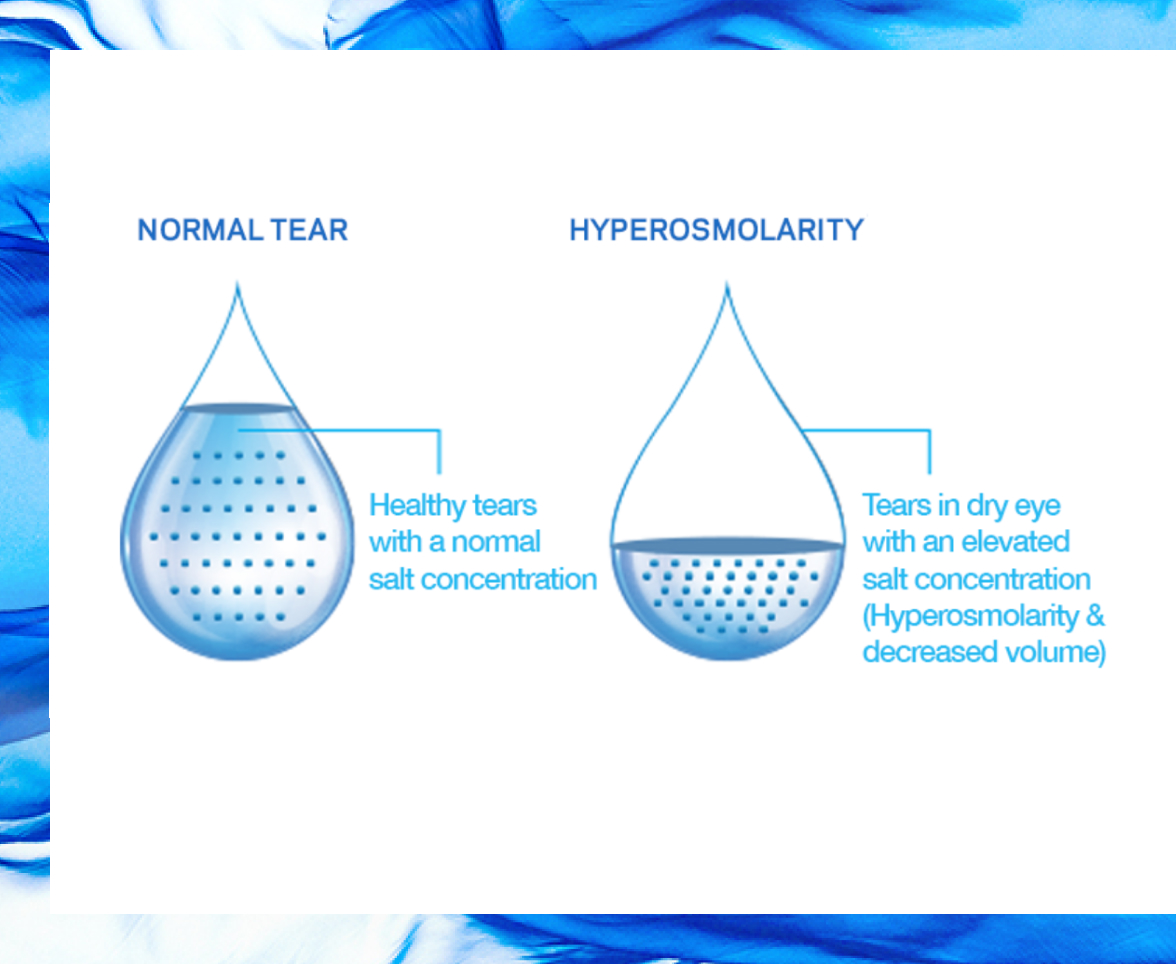 What Causes Dry Eyes